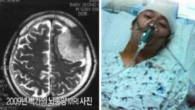   				코요태 빽가 뇌종양 당시 MRI 사진			