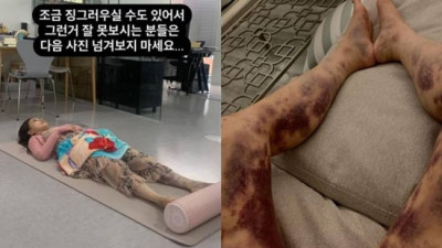 ‘전신 피멍’ 아옳이 13억 소송 4년만 승소