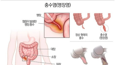 인류의 수명을 거의 두배로 늘려준 수술